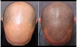 Hair-tattooing-camouflaging-tricks-face-value-hair-transplant-clinic-in mumbai-india